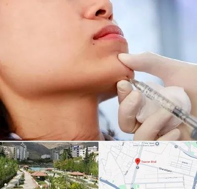 زاویه سازی صورت در بلوار تعاون