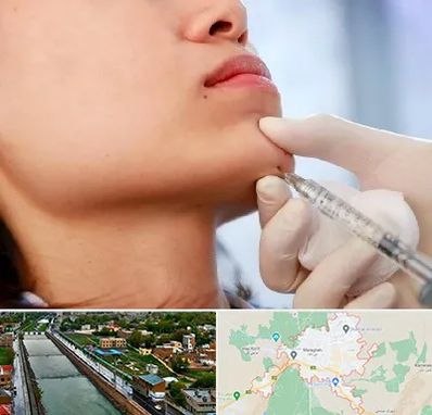 زاویه سازی صورت در مراغه