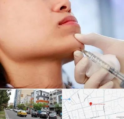 زاویه سازی صورت در هفده شهریور تبریز