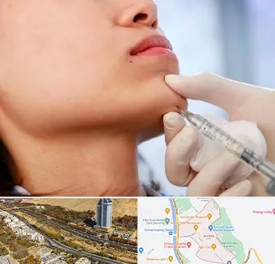 زاویه سازی صورت در خیابان نیایش شیراز 