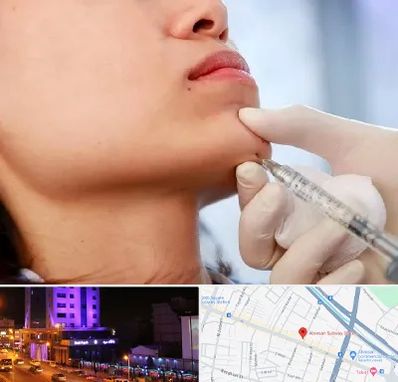 زاویه سازی صورت در آبرسان تبریز