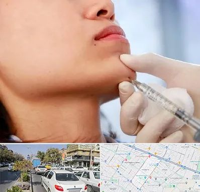 زاویه سازی صورت در مفتح مشهد 