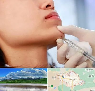 زاویه سازی صورت در مرند