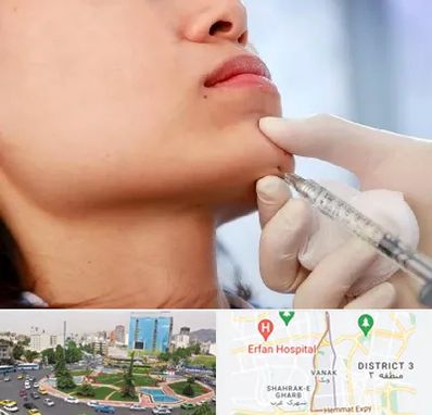 زاویه سازی صورت در ونک 