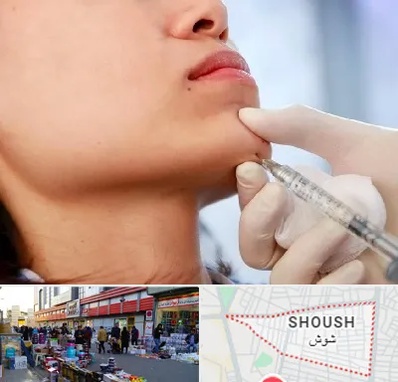 زاویه سازی صورت در شوش