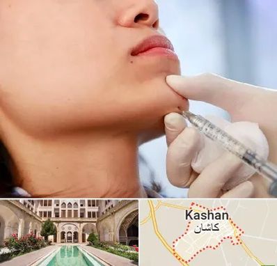 زاویه سازی صورت در کاشان