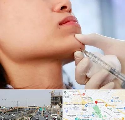 زاویه سازی صورت در بلوار توس مشهد 