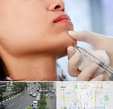 زاویه سازی صورت در ستارخان 