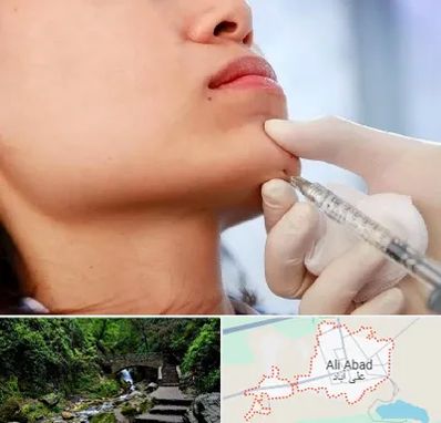 زاویه سازی صورت در علی آباد کتول