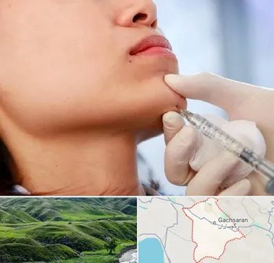 زاویه سازی صورت در گچساران