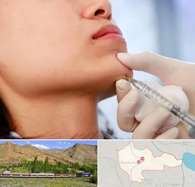 زاویه سازی صورت در خاش