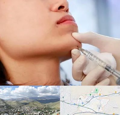 زاویه سازی صورت در رودهن