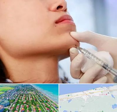 زاویه سازی صورت در فریدونکنار