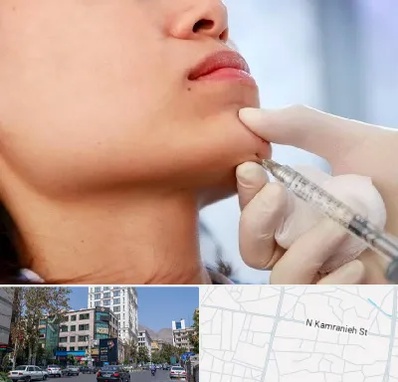 زاویه سازی صورت در کامرانیه