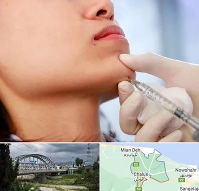 زاویه سازی صورت در چالوس