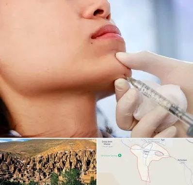 زاویه سازی صورت در اسکو