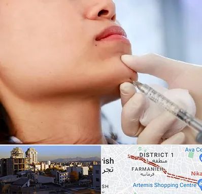 زاویه سازی صورت در فرمانیه 