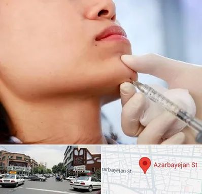 زاویه سازی صورت در خیابان آذربایجان