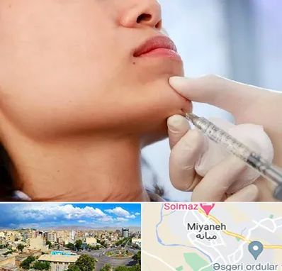زاویه سازی صورت در میانه