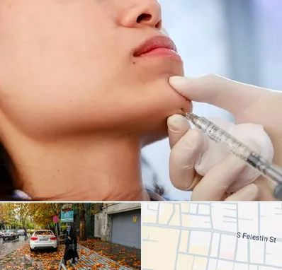 زاویه سازی صورت در خیابان فلسطین