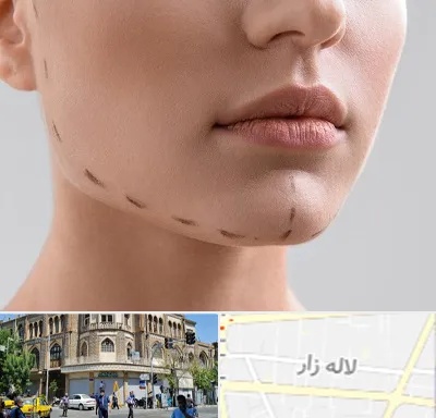 عمل زاویه فک در لاله زار
