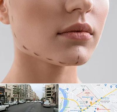 عمل زاویه فک در زیتون کارمندی اهواز