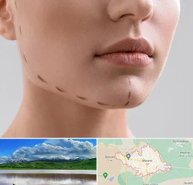 عمل زاویه فک در مرند