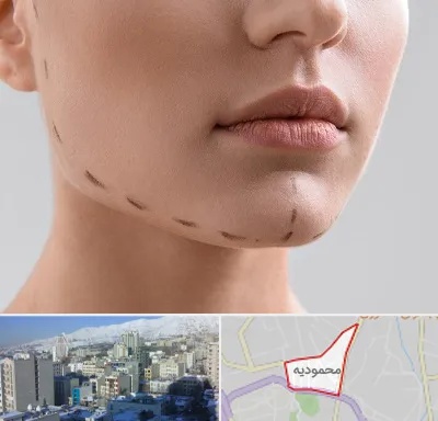 عمل زاویه فک در محمودیه