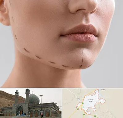 عمل زاویه فک در شهرضا