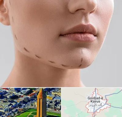 عمل زاویه فک در گنبد کاووس
