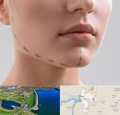 عمل زاویه فک در مهاباد