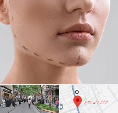 عمل زاویه فک در ولیعصر شهریار