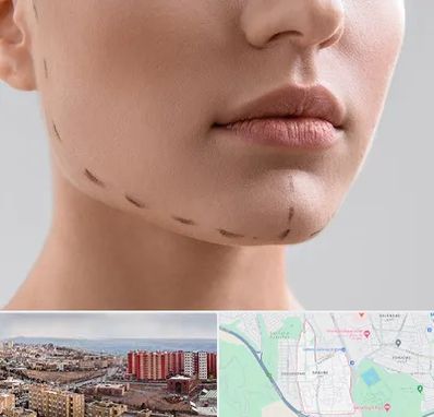 عمل زاویه فک در سهند تبریز