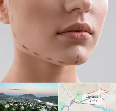 عمل زاویه فک در لواسان