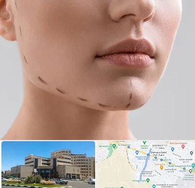 عمل زاویه فک در صیاد شیرازی مشهد