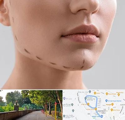 عمل زاویه فک در فلکه گاز رشت