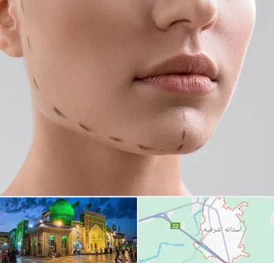 عمل زاویه فک در آستانه اشرفیه