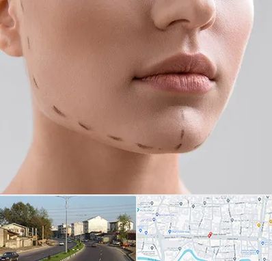 عمل زاویه فک در ضیابری رشت