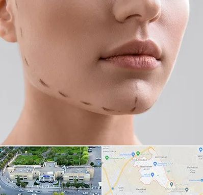 عمل زاویه فک در نسیم شهر