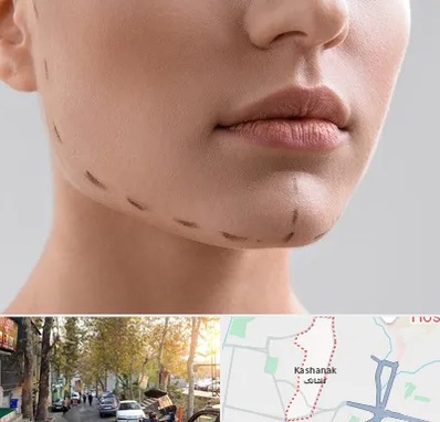 عمل زاویه فک در کاشانک