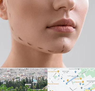 عمل زاویه فک در محلاتی شیراز