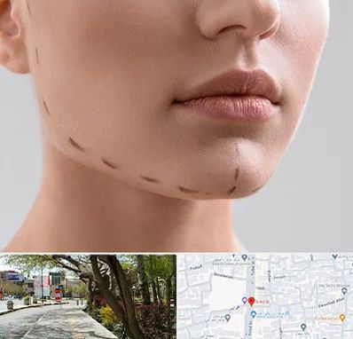 عمل زاویه فک در خیابان توحید اصفهان