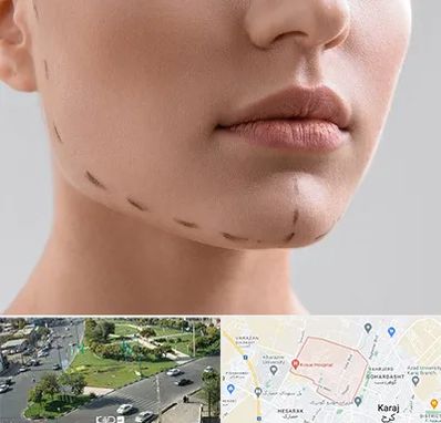 عمل زاویه فک در شاهین ویلا کرج