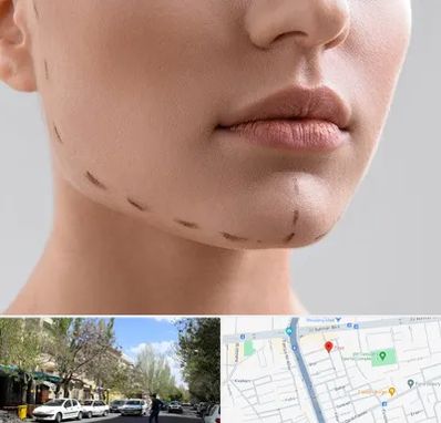 عمل زاویه فک در کوی فیروز تبریز