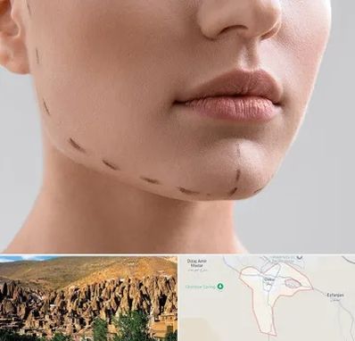 عمل زاویه فک در اسکو