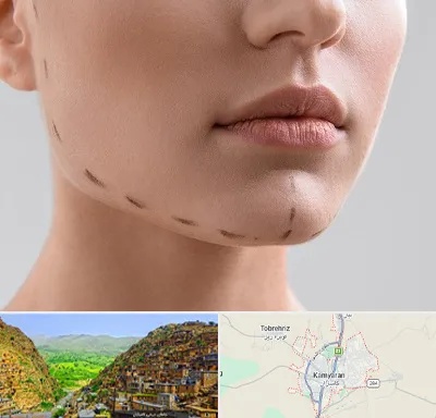 عمل زاویه فک در کامیاران