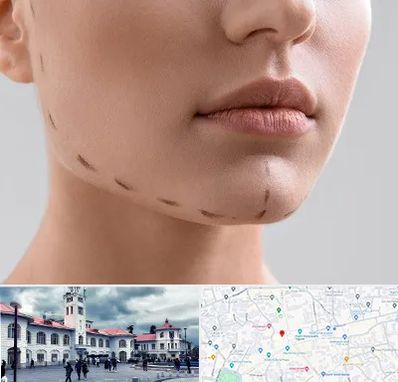 عمل زاویه فک در میدان شهرداری رشت