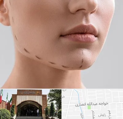 عمل زاویه فک در خواجه عبدالله