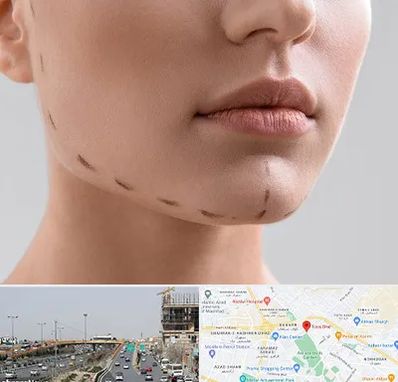 عمل زاویه فک در بلوار توس مشهد