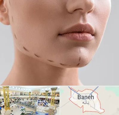 عمل زاویه فک در بانه